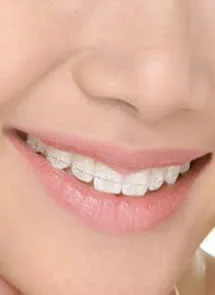 brackets ceramicos.webp