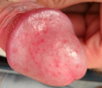 balanitis.jpg