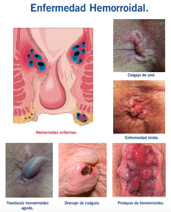 hemorroides varios .png